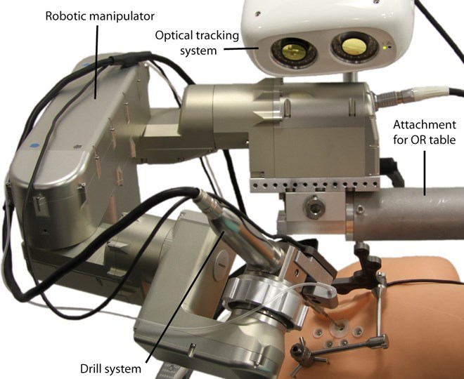 Seriously, this skull-drilling robot is good news for humanity